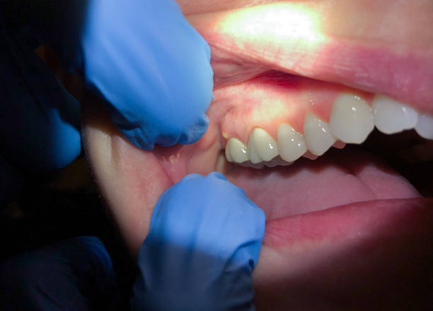 Best Emergency Dental Care for Broken or Chipped Teeth in Fremont, IN